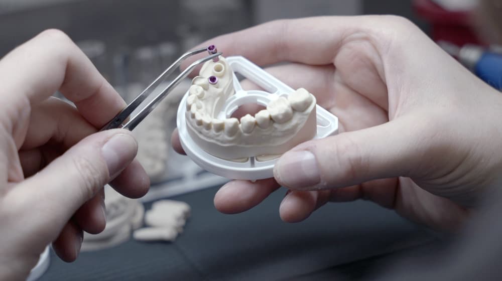 Techniker platziert Implantatanaloge in einem präzisen 3D-gedruckten oder CAD/CAM-gefrästen Arbeitsmodell. Moderne digitale Zahntechnik von CCDE in Mönchengladbach.