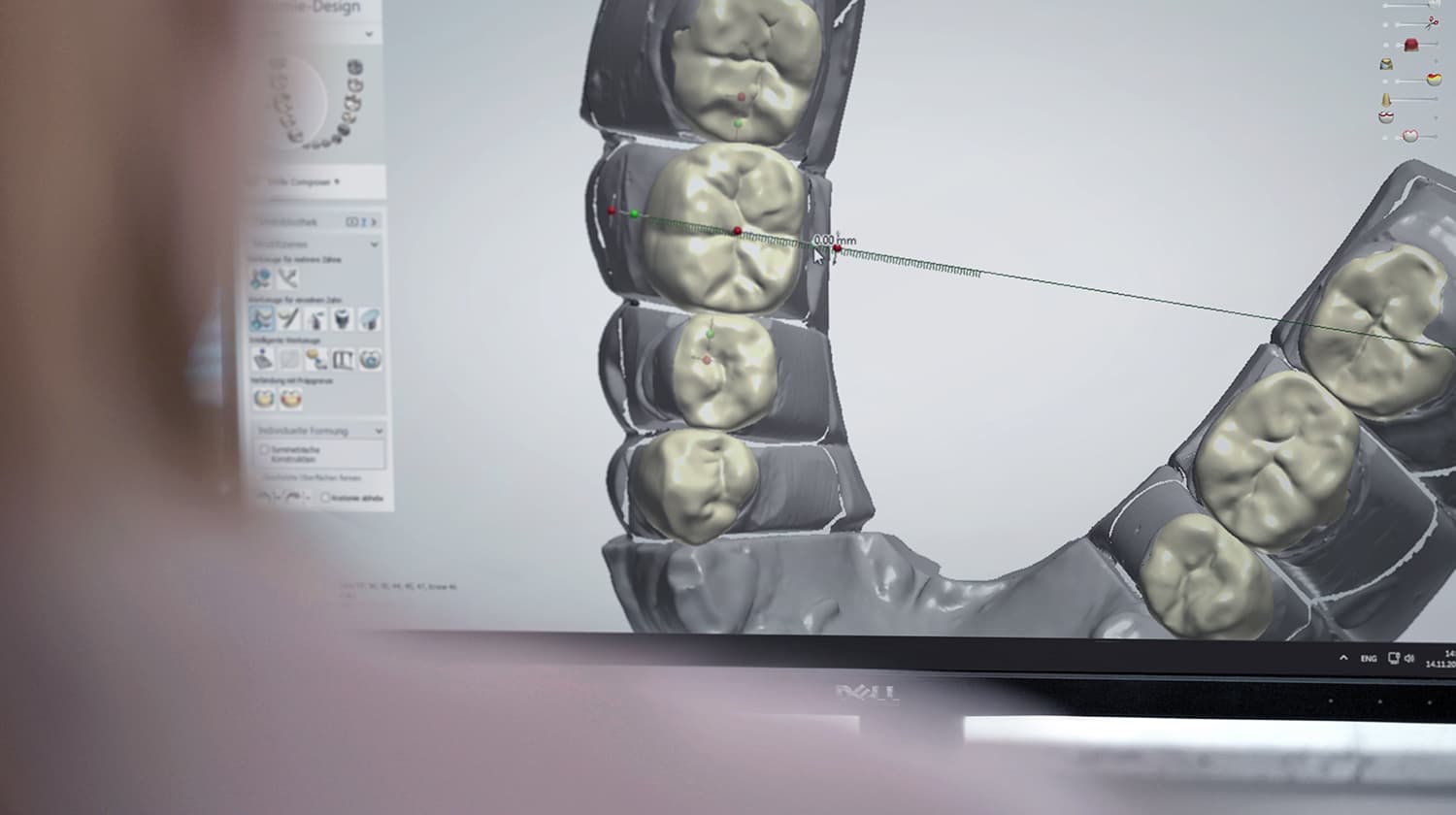 Digitales Design von Zahnersatz (Kronen) in der CAD-Software. Präzise Gestaltung mittels digitaler Zahntechnik im CCDE Dentallabor in Mönchengladbach.