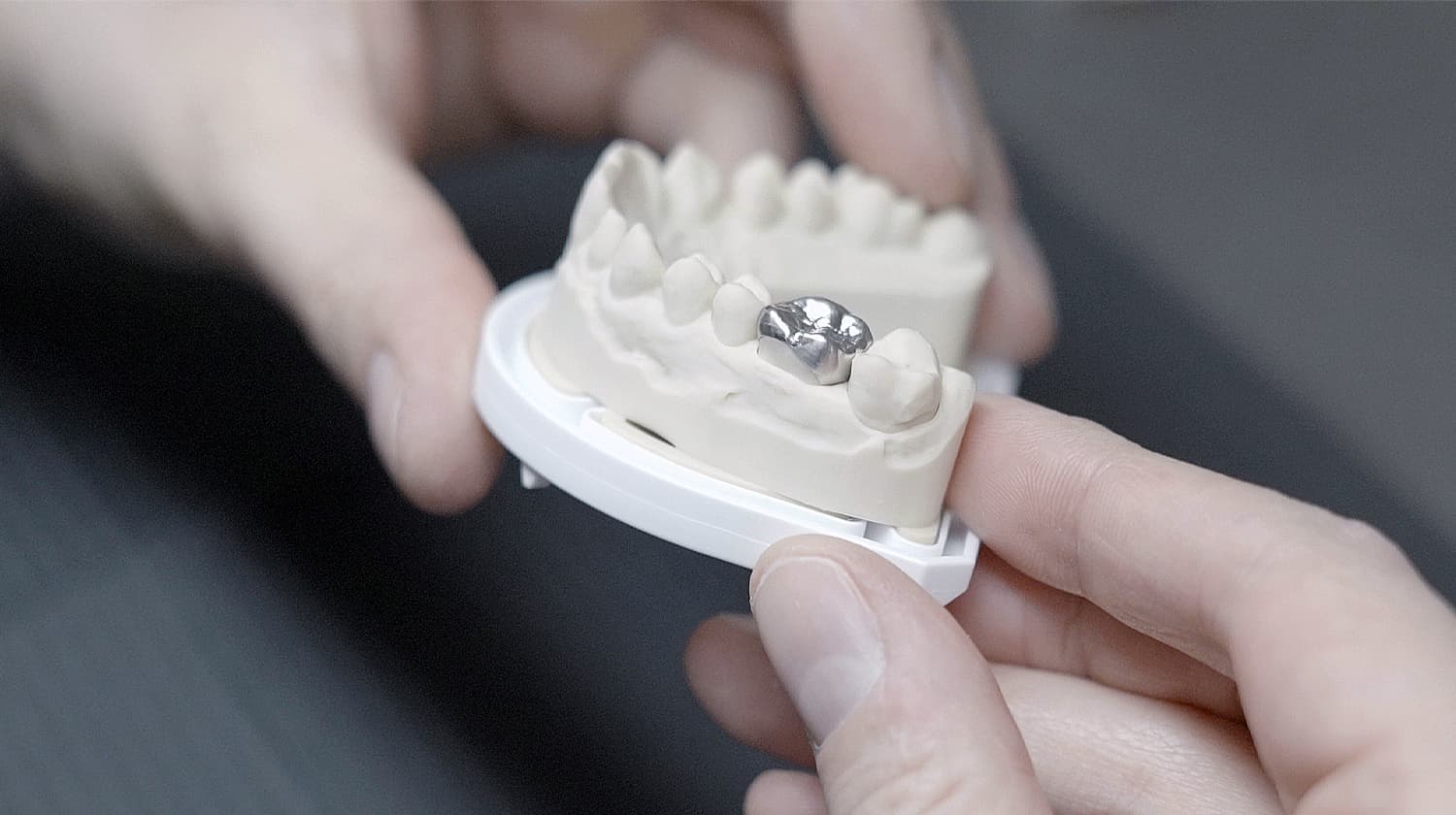 Hochwertige Einzelkrone aus Metall in Okklusalansicht, präzise passend auf einem Oberkiefer-Arbeitsmodell. Ein Beispiel für festsitzenden Zahnersatz von CCDE in Mönchengladbach.