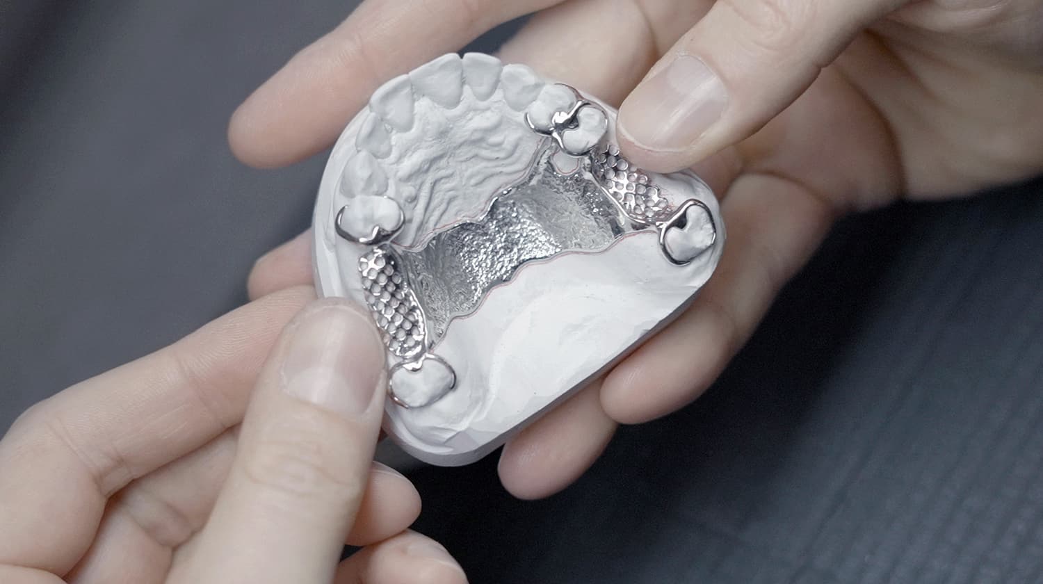 Hochwertiges Modellguss-Metallgerüst für eine Teilprothese, eingesetzt auf einem Unterkiefer-Gipsmodell. Präzise Handwerksarbeit aus dem CCDE Dentallabor in Mönchengladbach.