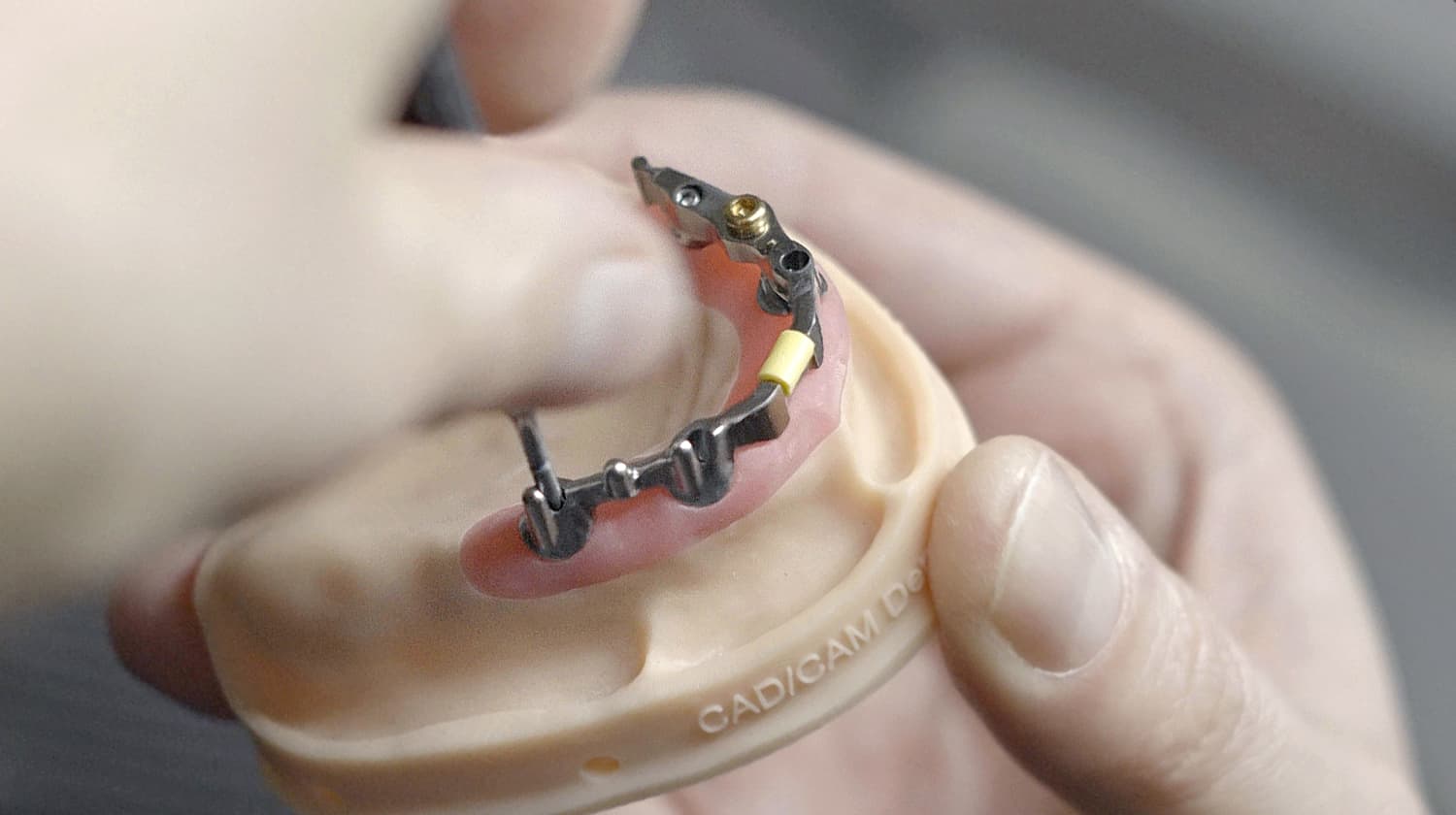 Implantatgetragene Stegkonstruktion aus Metall auf einem zahntechnischen Kiefermodell, bereit für einen stabilen Zahnersatz. Hergestellt im CAD/CAM-Verfahren bei CCDE in Mönchengladbach.
