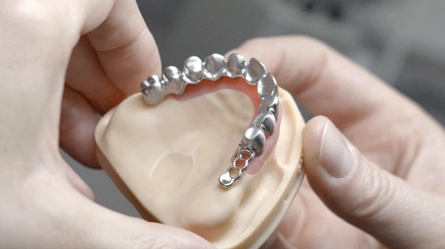 Hochpräziser metallischer Zahnersatz (Teleskoparbeit) für eine Teilprothese, gehalten auf einem Kiefermodell. Detailaufnahme aus dem CCDE Dentallabor in Mönchengladbach.
